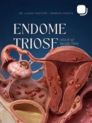 Publicação do Dr. Lucas Pastore com o título “Endometriose não é só tecido fora do útero”